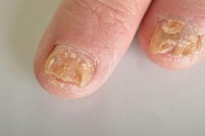 leczenie grzybicy paznokci warszawa