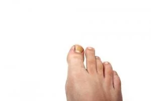 leczenie wrastających paznokci warszawa
