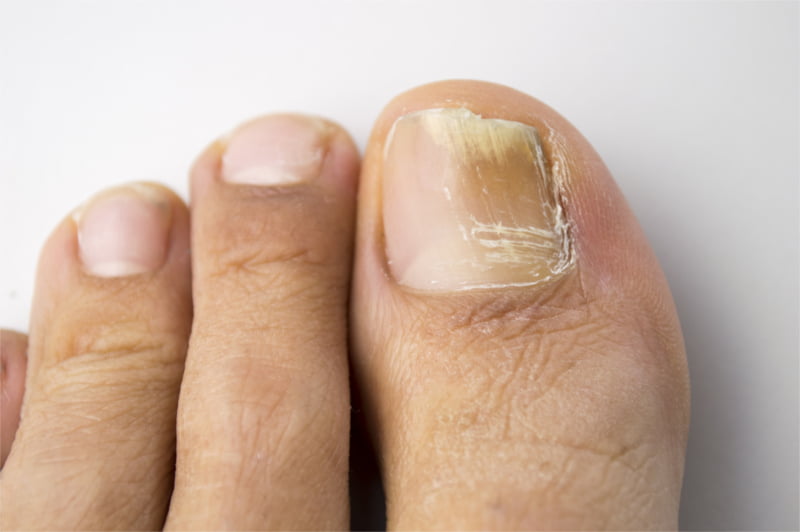 onycholiza objawy przyczyny leczenie podolog warszawa jaki akryl do paznokci eveline lakier zelowy