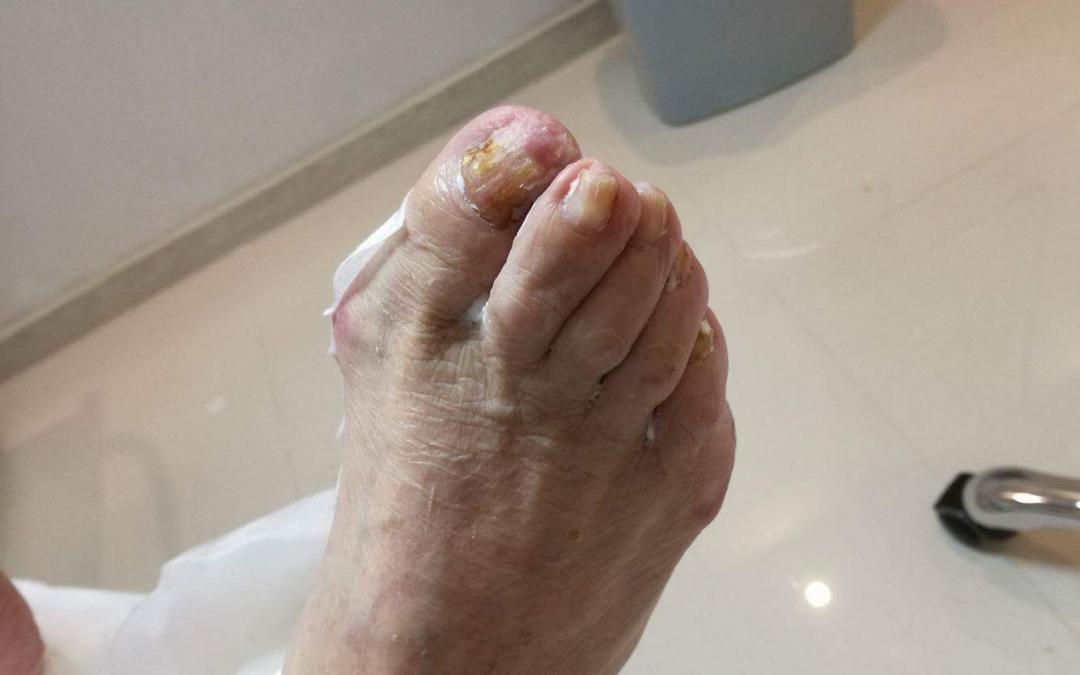 Nadmierna potliwość stóp – jak poradzić sobie z problemem?