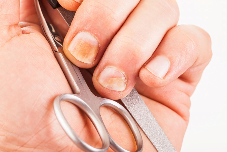 Wrastające paznokcie – leczenie nieinwazyjne Warszawa