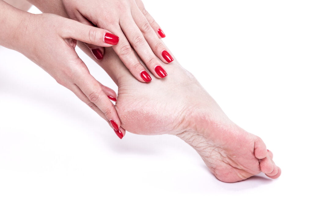 Grzybica stóp – czym jest i jak ją leczyć?